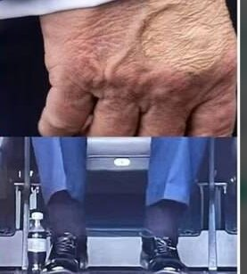 بیماری ترامپ